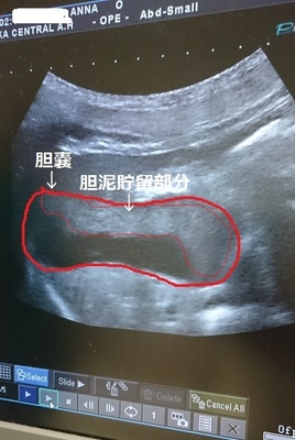エコー、胆泥.jpg