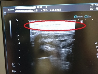 十二指腸の縦線.jpg